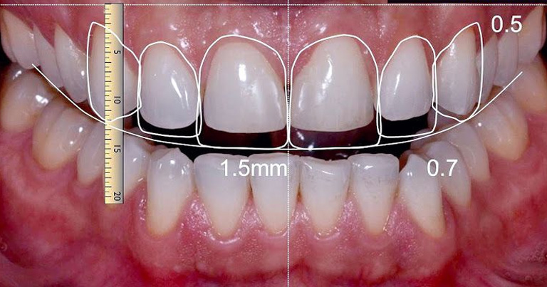 Arcos para el tratamiento de ortodoncia - [Odontostore]