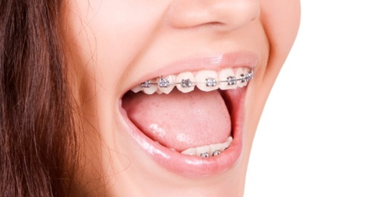 Arcos para el tratamiento de ortodoncia