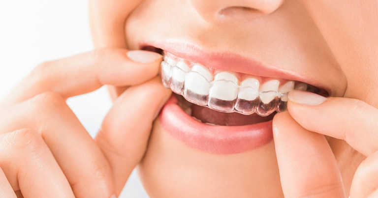 Beneficios de la ortodoncia invisible para pacientes periodontales