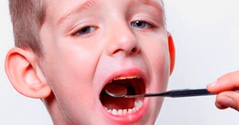Datos sobre la caries dental