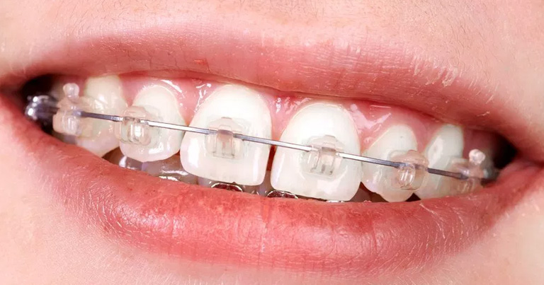 Los arcos iniciales en tratamientos de ortodoncia