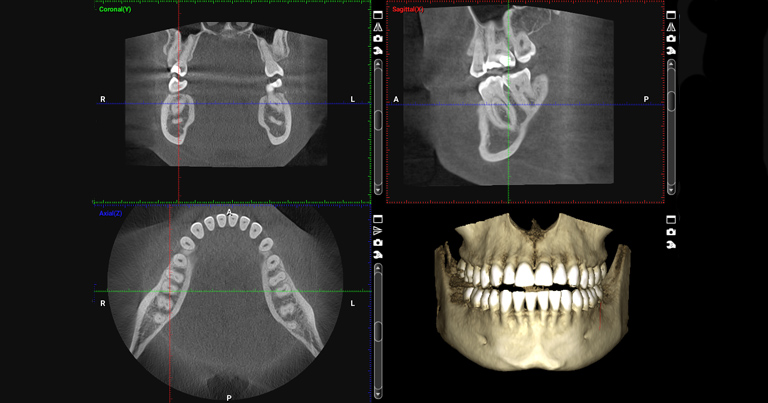 Los beneficios del sistema Cone Beam