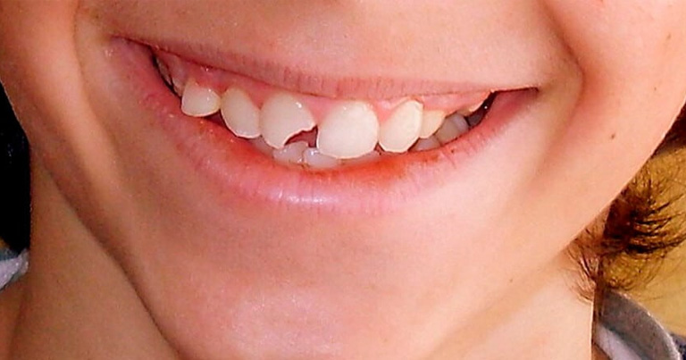 Traumatismo dental en niños ¿Qué hacer?
